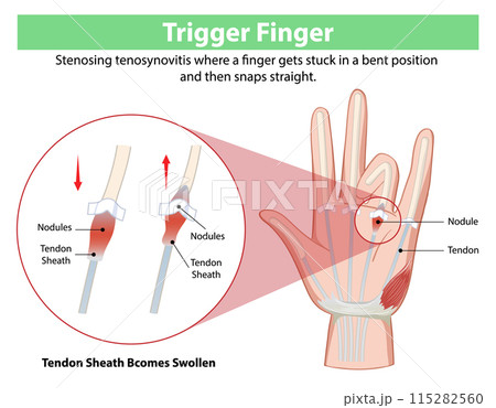 Trigger Finger Medical Illustration 115282560