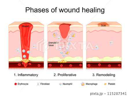Wound healing process. Tissue repair 115287341