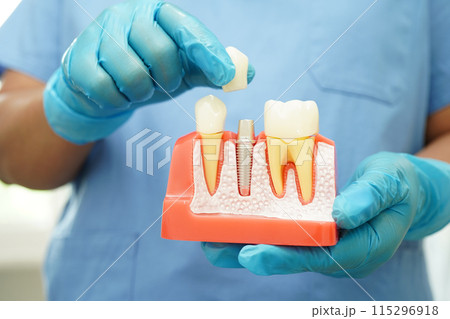 Doctor hold dental implant, artificial tooth roots into jaw, root canal of dental treatment, gum disease, teeth model for dentist studying about dentistry. 115296918