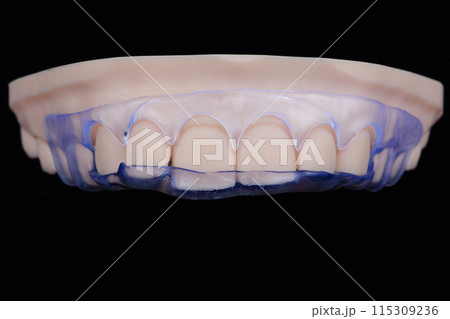3D printed transparent dental template for gum correction fixed on model on black background. 115309236