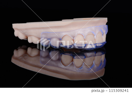 3D printed transparent dental template for gum correction fixed on model on black background. 115309241