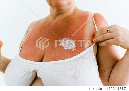 sunburn on woman's body is lubricated with moisturizer 115319217