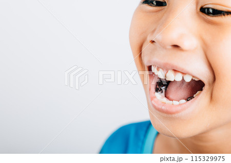 Dental image of a stainless steel crown a silver cap used for restoring children's teeth affected by decay or fractures. Dental care concept. Steel crown silver caps for kid problem teeth. Dental image of a stainless steel crown a silver cap used for restoring children's teeth affected by decay or fractures. Dental care concept. Steel crown silver caps for kid problem teeth. 115329975