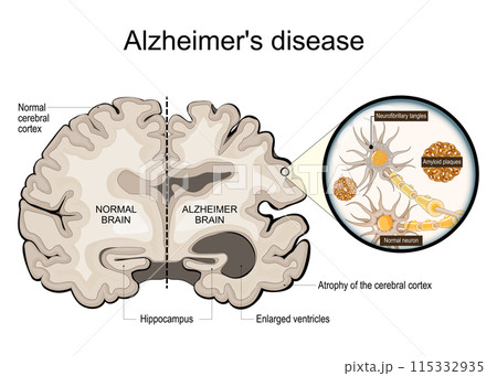 Alzheimer disease. Hippocampus. Close-up of neurons with Neurofibrillary tangles, Amyloid plaques Alzheimer disease. Hippocampus. Close-up of neurons with Neurofibrillary tangles, Amyloid plaques 115332935