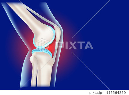 Knee joint inflammation. Realistic human knee Knee joint inflammation. Realistic human knee 115364230