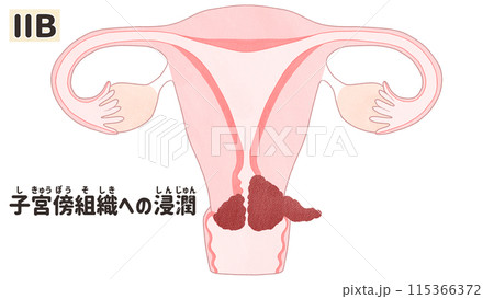 子宮頸がんステージⅡB(2B期) わかりやすい日本語図解イラスト 子宮頸がんステージⅡB(2B期) わかりやすい日本語図解イラスト 115366372