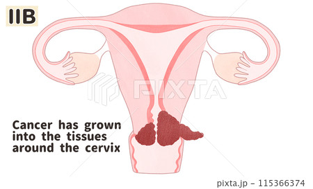 子宮頸がんステージⅡB（2B期）　わかりやすい英語図解イラスト 115366374