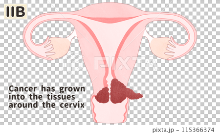 子宮頸がんステージⅡB（2B期）　わかりやすい英語図解イラスト 115366374