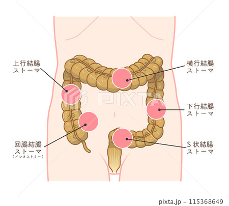 人工肛門、ストーマ、大腸、イラスト、illustration 115368649
