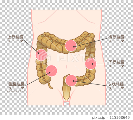 人工肛門、ストーマ、大腸、イラスト、illustration 115368649