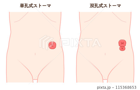 人工肛門、ストーマ、大腸、イラスト、illustration 115368653