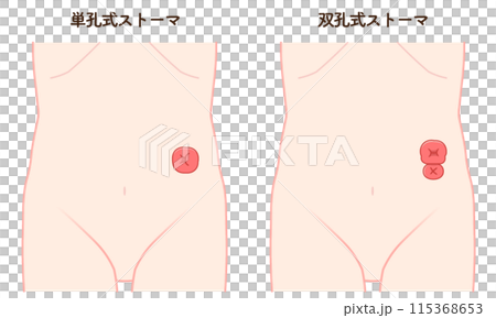 人工肛門、ストーマ、大腸、イラスト、illustration 115368653