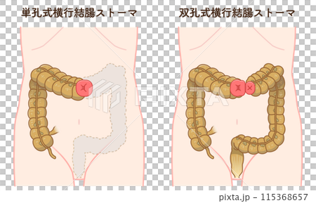 Colostomy, stoma, colon, illustration Colostomy, stoma, colon, illustration 115368657