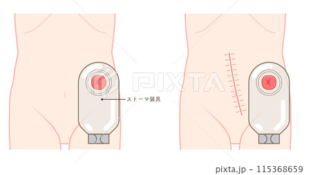 人工肛門、ストーマ、大腸、イラスト、illustration 115368659