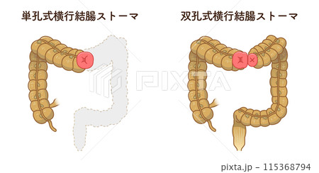 人工肛門、ストーマ、大腸、イラスト、illustration 人工肛門、ストーマ、大腸、イラスト、illustration 115368794