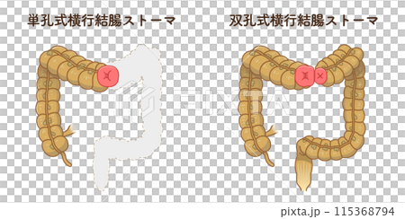 人工肛門、ストーマ、大腸、イラスト、illustration 人工肛門、ストーマ、大腸、イラスト、illustration 115368794