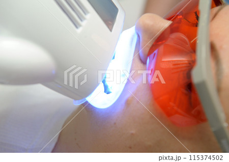 close-up of a woman's face under the apparatus Beyond Poluse Plus Advanced Whitening System with Dental UV Laser Whitening Device in glasses protective against ultraviolet whitening teeth 115374502