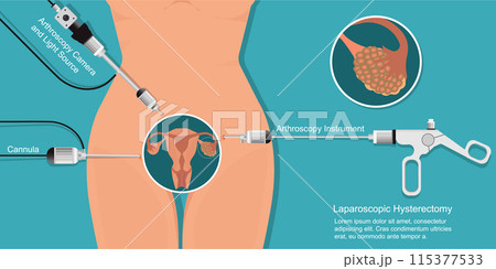 Laparoscopic fibroid removal is a minimally invasive procedure to remove uterine fibroids. 115377533