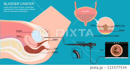 Evaluation of diagnostic strategies for bladder cancer using cystoscopy. 115377534