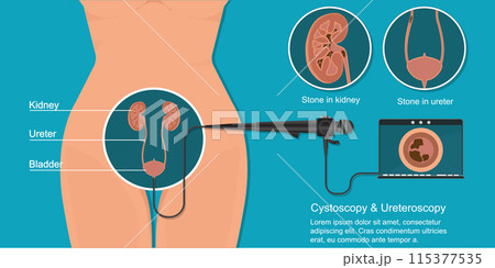 During a cystoscopy, the doctor passes the tube into the bladder. 115377535