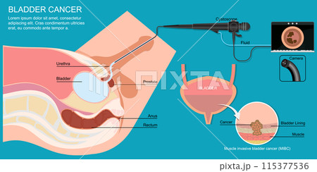Cystoscopy enables the inside of the urethra and bladder to be examined and sampled. 115377536