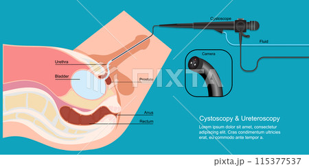 Cystoscopy allows a health care provider to view the lower urinary. Cystoscopy allows a health care provider to view the lower urinary. 115377537