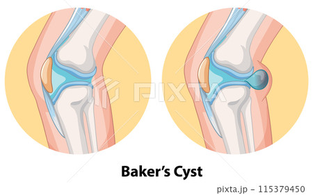 Baker's Cyst in Knee Joint Baker's Cyst in Knee Joint 115379450