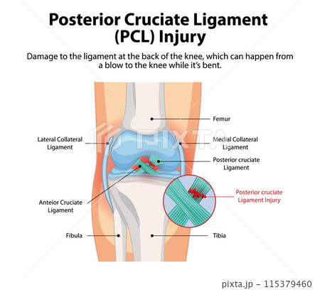 Posterior Cruciate Ligament Injury Diagram Posterior Cruciate Ligament Injury Diagram 115379460