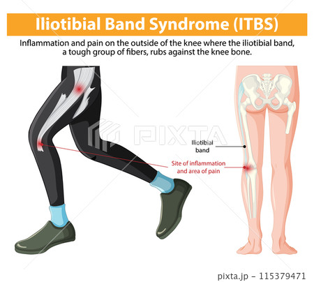 Iliotibial Band Syndrome (ITBS) Illustration Iliotibial Band Syndrome (ITBS) Illustration 115379471