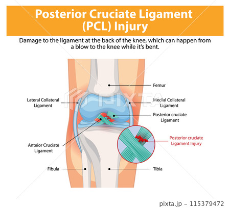 Posterior Cruciate Ligament (PCL) Injury 115379472
