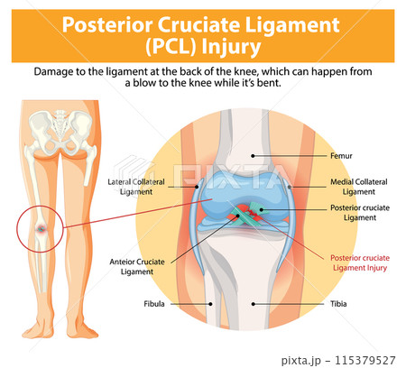 Posterior Cruciate Ligament (PCL) Injury 115379527
