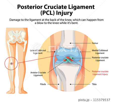 Posterior Cruciate Ligament (PCL) Injury Posterior Cruciate Ligament (PCL) Injury 115379537