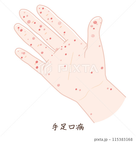 手、足、手足口病のイラスト、HFMD、illustration 115383168