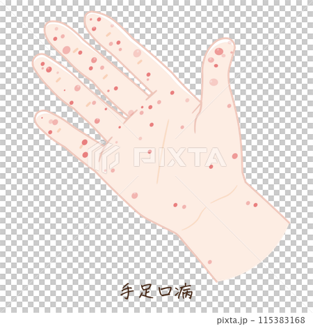 手、足、手足口病のイラスト、HFMD、illustration 115383168