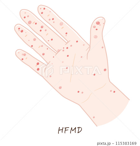 手、足、手足口病のイラスト、HFMD、illustration 115383169