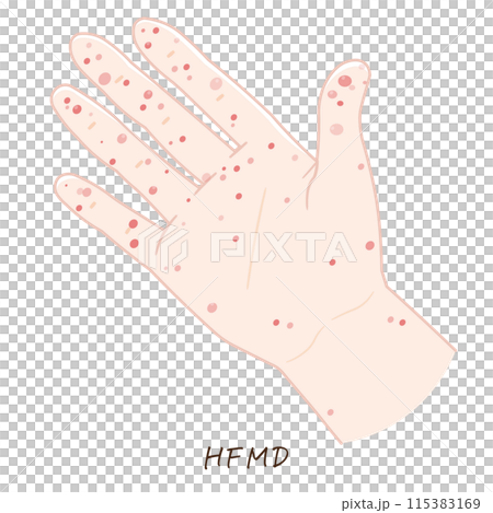 手、足、手足口病のイラスト、HFMD、illustration 115383169