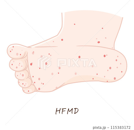 手、足、手足口病のイラスト、HFMD、illustration 115383172