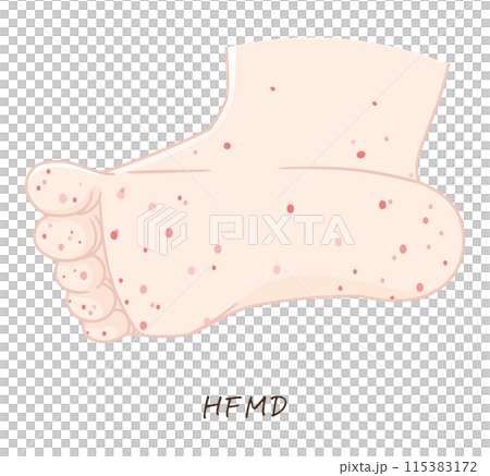 Hand, foot and mouth disease illustration, HFMD, illustration 115383172