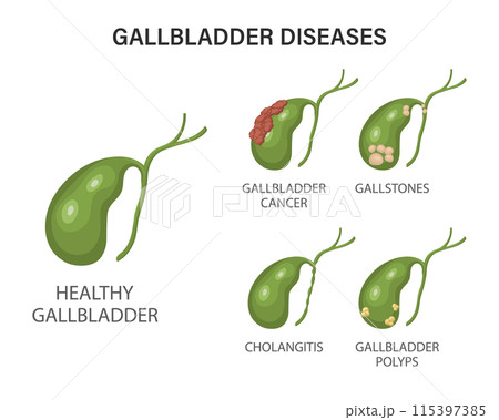 Gallbladder diseases infographics. Gallstone disease, cancer, acute cholecystitis, cholangitis or polyps of the digestive system. Problems with the biliary tract. Illustration. Gallbladder diseases infographics. Gallstone disease, cancer, acute cholecystitis, cholangitis or polyps of the digestive system. Problems with the biliary tract. Illustration. 115397385