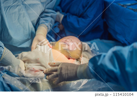 A baby is delivered in an intact amniotic sac during a caesarean section. The medical team carefully performs the procedure, highlighting the precision and care involved in this unique birth scenario 115410104