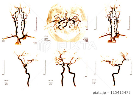 Cerebrovascular in the brain Cerebrovascular in the brain 115415475