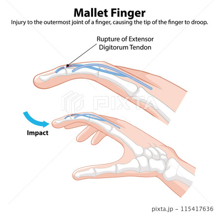 Mallet Finger Injury Illustration 115417636