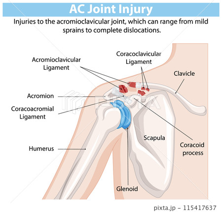 AC Joint Injury Diagram AC Joint Injury Diagram 115417637