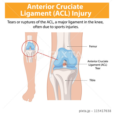 Anterior Cruciate Ligament (ACL) Injury Anterior Cruciate Ligament (ACL) Injury 115417638