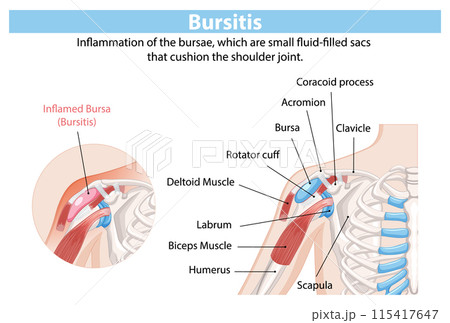 Shoulder Bursitis Medical Illustration 115417647