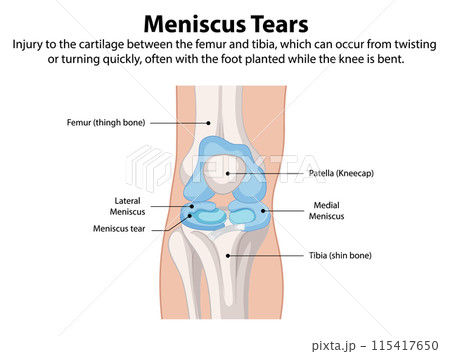 Meniscus Tears in the Knee 115417650