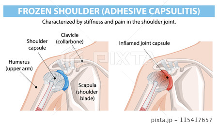 Frozen Shoulder Medical Illustration Frozen Shoulder Medical Illustration 115417657