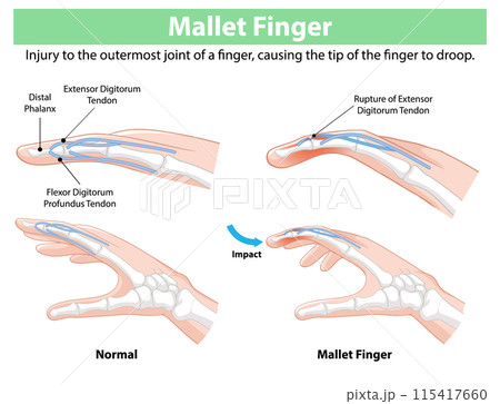 Mallet Finger Injury Illustrationのイラスト素材 [115417660] - PIXTA