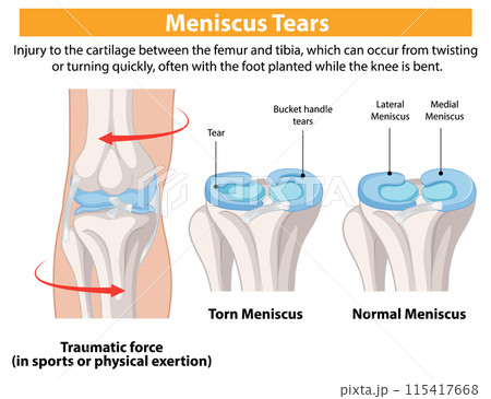 Understanding Meniscus Tears in Knees 115417668