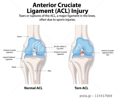 ACL Injury: Normal vs. Torn ACL Injury: Normal vs. Torn 115417669
